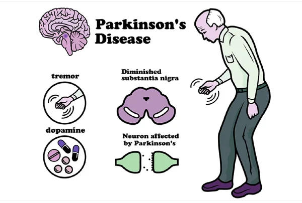Parkinson