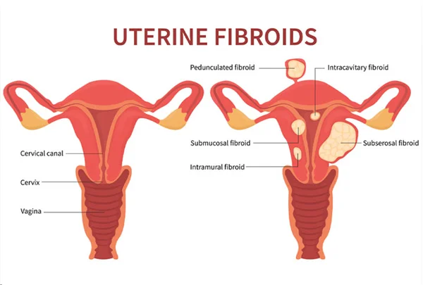 Uterine Fibroids