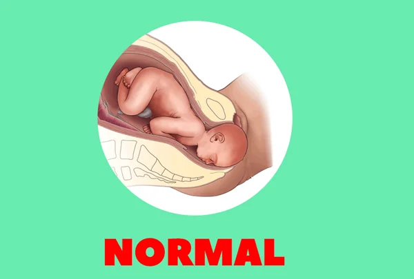 Normal Delivery