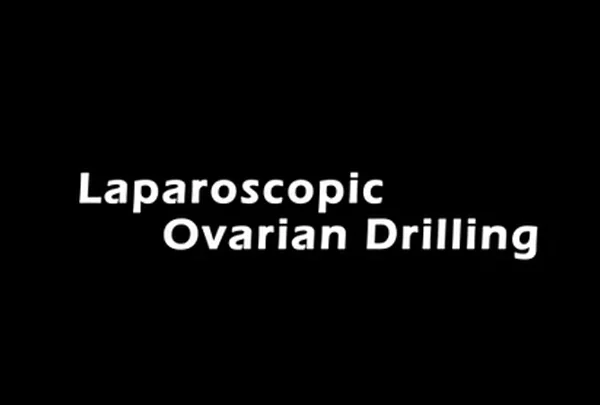 Laparoscopic Ovarian Drilling