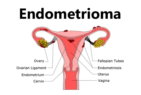 Endometrioma