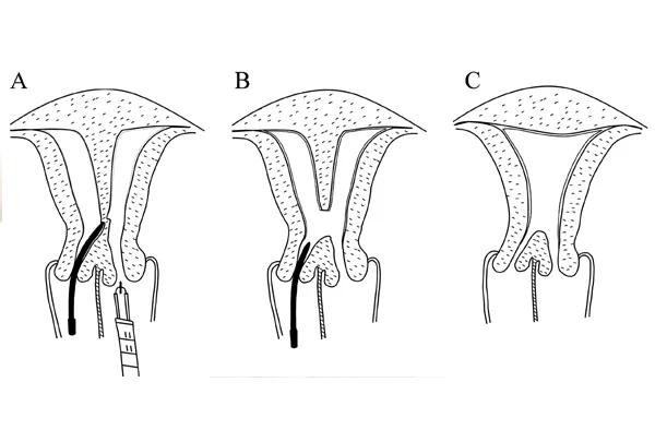 Hysteroscopy Septum Resection