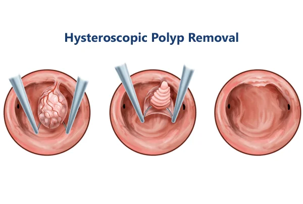 Hysteroscopy Polyp Removal