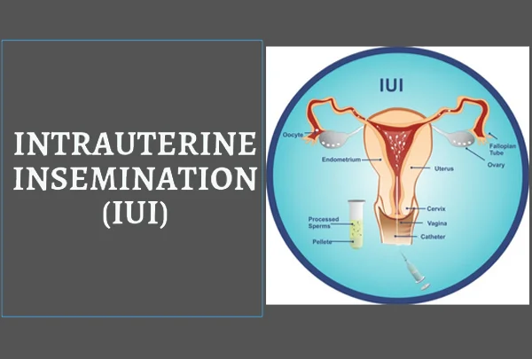 Intra Uterine Insemination (IUI)