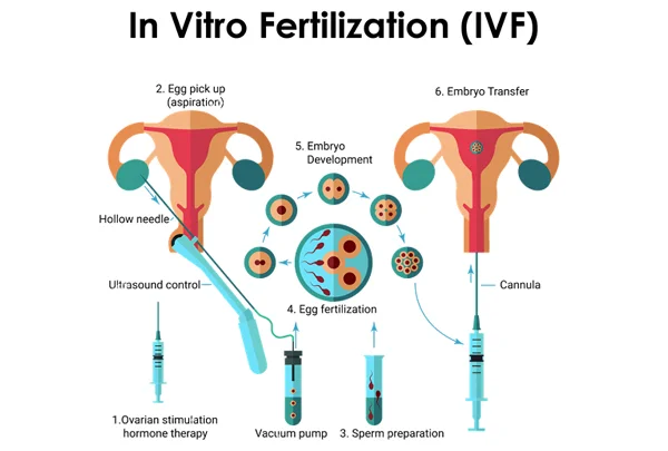 In Vitro Fertilization (IVF)