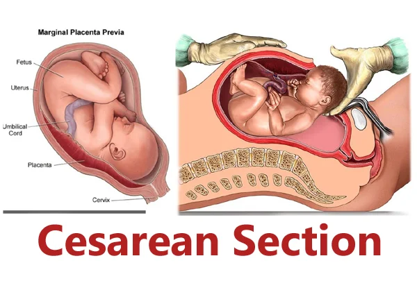 Cesarean Section