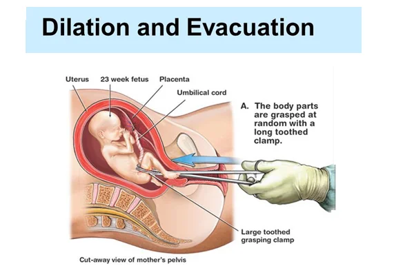 Dilation and Evacuation